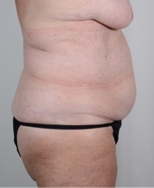 Tummy Tuck Before Photo by R. Scott Yarish, MD; Houston, TX - Case 45965