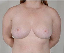 Breast Reduction After Photo by R. Scott Yarish, MD; Houston, TX - Case 45967