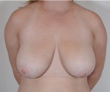 Breast Reduction Before Photo by R. Scott Yarish, MD; Houston, TX - Case 45967