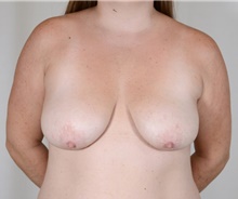 Breast Lift Before Photo by R. Scott Yarish, MD; Houston, TX - Case 45971