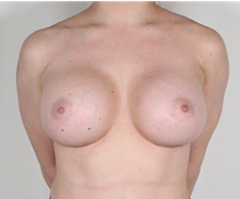 Breast Augmentation After Photo by R. Scott Yarish, MD; Houston, TX - Case 45972