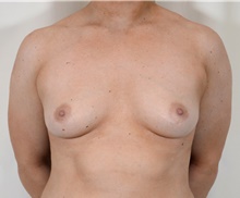 Breast Augmentation Before Photo by R. Scott Yarish, MD; Houston, TX - Case 45972