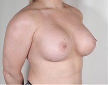 Breast Augmentation After Photo by R. Scott Yarish, MD; Houston, TX - Case 45972