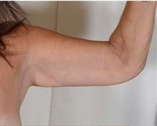 Arm Lift After Photo by R. Scott Yarish, MD; Houston, TX - Case 45975