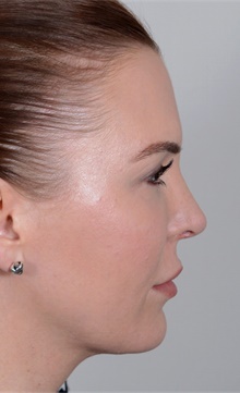 Rhinoplasty After Photo by R. Scott Yarish, MD; Houston, TX - Case 45976