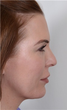 Rhinoplasty Before Photo by R. Scott Yarish, MD; Houston, TX - Case 45976