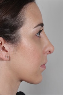 Rhinoplasty After Photo by R. Scott Yarish, MD; Houston, TX - Case 45977