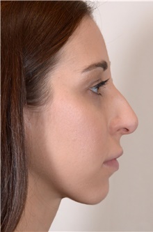 Rhinoplasty Before Photo by R. Scott Yarish, MD; Houston, TX - Case 45977