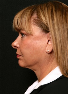 Facelift After Photo by George Toledo, MD; Dallas, TX - Case 34747