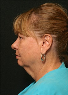 Facelift Before Photo by George Toledo, MD; Dallas, TX - Case 34747