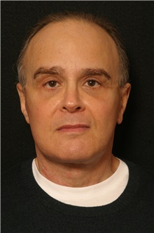 Facelift After Photo by George Toledo, MD; Dallas, TX - Case 34757