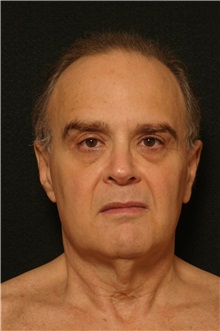 Facelift Before Photo by George Toledo, MD; Dallas, TX - Case 34757