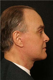 Facelift After Photo by George Toledo, MD; Dallas, TX - Case 34757
