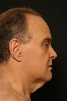 Facelift Before Photo by George Toledo, MD; Dallas, TX - Case 34757