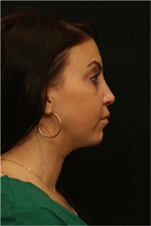 Rhinoplasty After Photo by George Toledo, MD; Dallas, TX - Case 34788