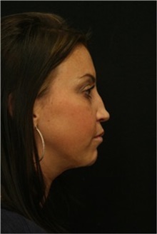 Rhinoplasty Before Photo by George Toledo, MD; Dallas, TX - Case 34788