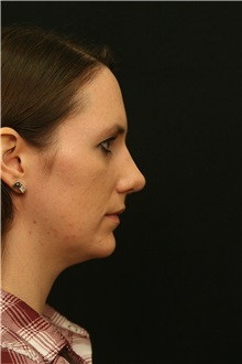 Rhinoplasty After Photo by George Toledo, MD; Dallas, TX - Case 34793
