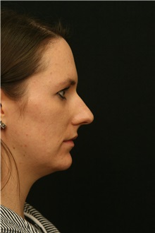 Rhinoplasty Before Photo by George Toledo, MD; Dallas, TX - Case 34793
