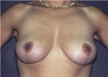 Breast Lift After Photo by George Toledo, MD; Dallas, TX - Case 34898