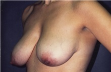 Breast Lift Before Photo by George Toledo, MD; Dallas, TX - Case 34898