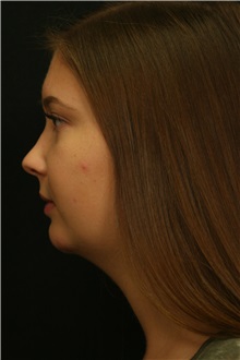 Chin Augmentation After Photo by George Toledo, MD; Dallas, TX - Case 34901