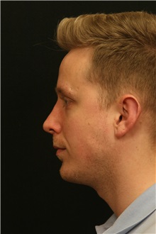 Chin Augmentation After Photo by George Toledo, MD; Dallas, TX - Case 34904