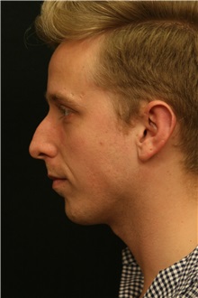 Chin Augmentation Before Photo by George Toledo, MD; Dallas, TX - Case 34904
