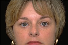Eyelid Surgery After Photo by George Toledo, MD; Dallas, TX - Case 34920