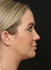 Chin Augmentation After Photo by George Toledo, MD; Dallas, TX - Case 41030