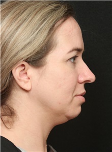 Chin Augmentation Before Photo by George Toledo, MD; Dallas, TX - Case 41030