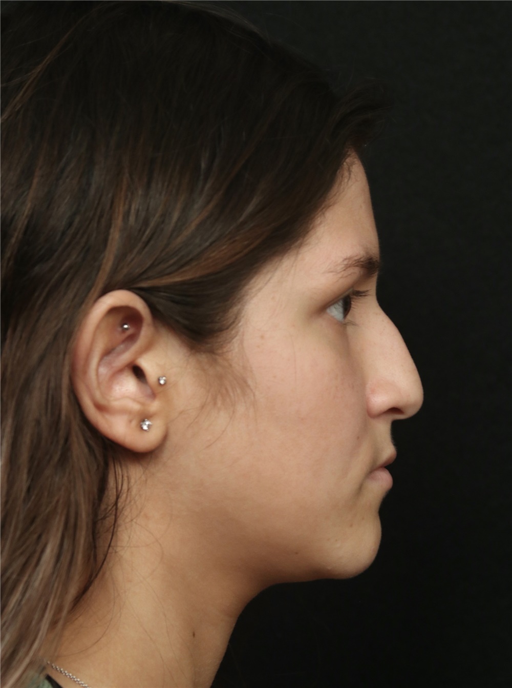 Rhinoplasty Before and After Photos by George Toledo, MD; Dallas, TX ...