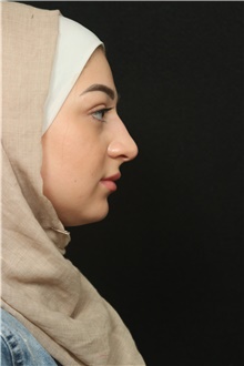Rhinoplasty Before Photo by George Toledo, MD; Dallas, TX - Case 41551
