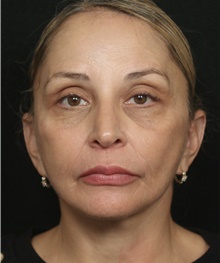 Lip Augmentation/Enhancement After Photo by George Toledo, MD; Dallas, TX - Case 42030