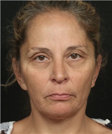 Lip Augmentation/Enhancement Before Photo by George Toledo, MD; Dallas, TX - Case 42030