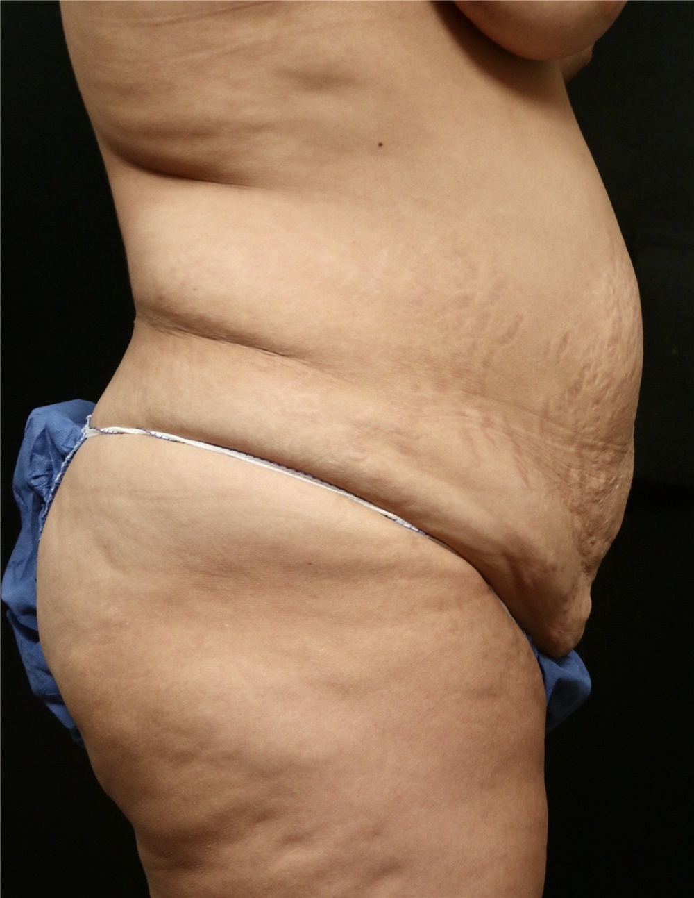 Tummy Tuck Before and After Photos by George Toledo, MD; Dallas, TX - Case  42162