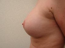 Breast Augmentation After Photo by Paul Albear, MD MBA; Tampa, FL - Case 9712