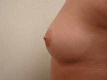 Breast Augmentation Before Photo by Paul Albear, MD MBA; Tampa, FL - Case 9712
