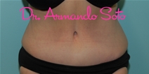 Tummy Tuck After Photo by Armando Soto, MD, FACS; Orlando, FL - Case 23440