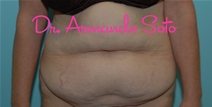 Tummy Tuck Before Photo by Armando Soto, MD, FACS; Orlando, FL - Case 23440