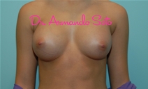 Breast Augmentation After Photo by Armando Soto, MD, FACS; Orlando, FL - Case 23441