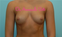 Breast Augmentation Before Photo by Armando Soto, MD, FACS; Orlando, FL - Case 23441