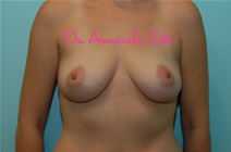 Breast Augmentation Before Photo by Armando Soto, MD, FACS; Orlando, FL - Case 23442