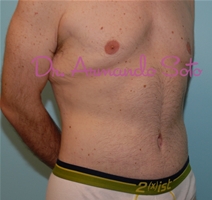Body Contouring After Photo by Armando Soto, MD, FACS; Orlando, FL - Case 23444