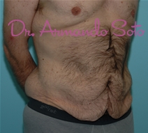 Body Contouring Before Photo by Armando Soto, MD, FACS; Orlando, FL - Case 23444