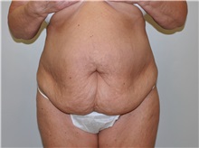 Tummy Tuck Before Photo by John Menard, MD; Tuscaloosa, AL - Case 35863