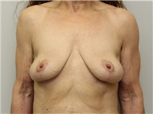 Breast Lift After Photo by John Menard, MD; Tuscaloosa, AL - Case 35924