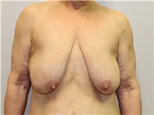 Breast Lift Before Photo by John Menard, MD; Tuscaloosa, AL - Case 35924