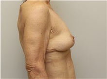 Breast Lift After Photo by John Menard, MD; Tuscaloosa, AL - Case 35924