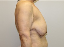 Breast Lift Before Photo by John Menard, MD; Tuscaloosa, AL - Case 35924