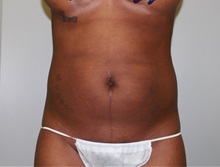 Liposuction After Photo by John Menard, MD; Tuscaloosa, AL - Case 35926